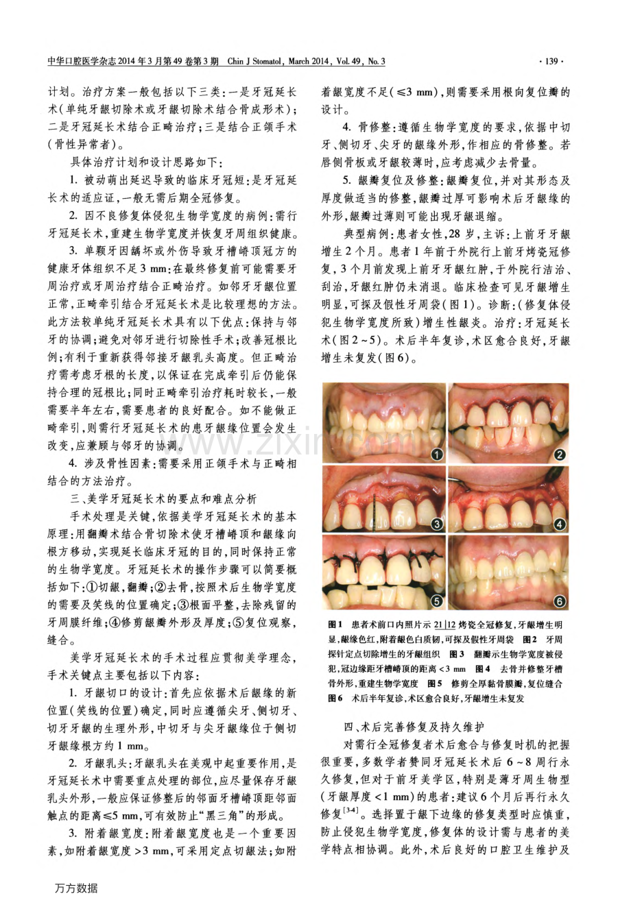 美学牙冠延长术的要点及难点分析.pdf_第2页