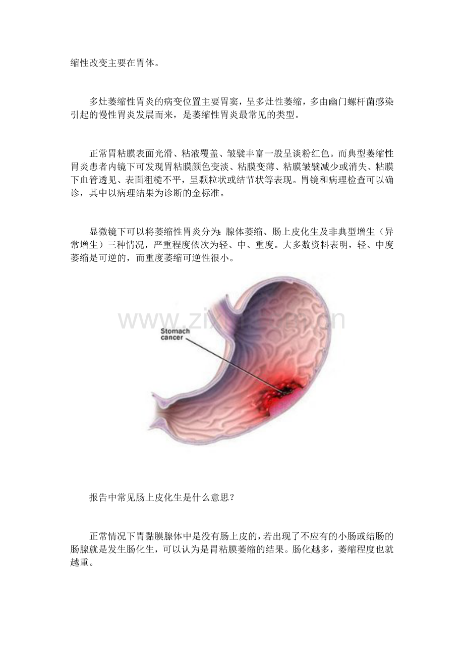 萎缩性胃炎的症状与分类.docx_第2页