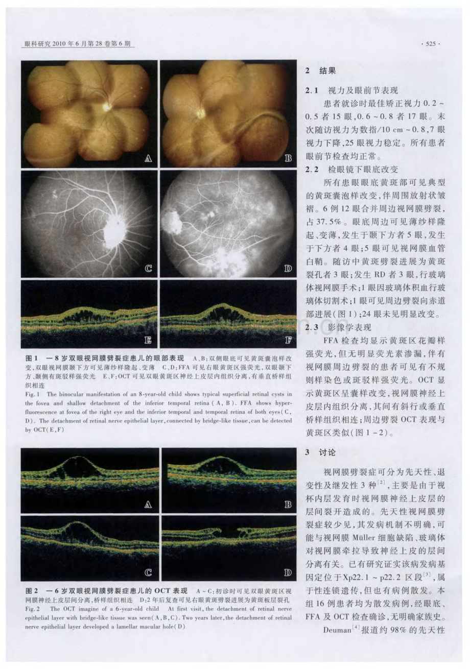 先天性视网膜劈裂症自然病程的临床观察.pdf_第2页