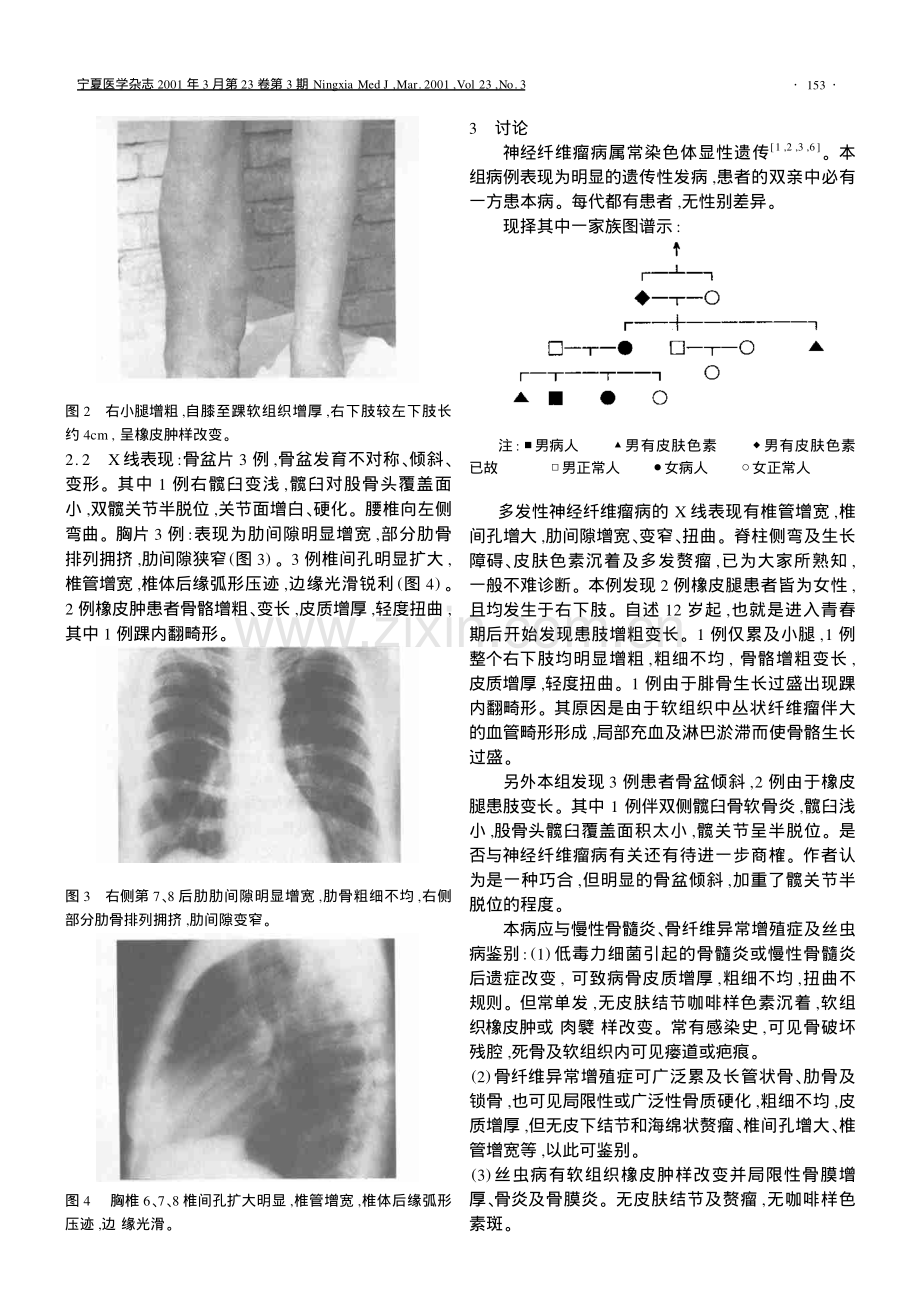 多发性神经纤维瘤的X线诊断.pdf_第2页