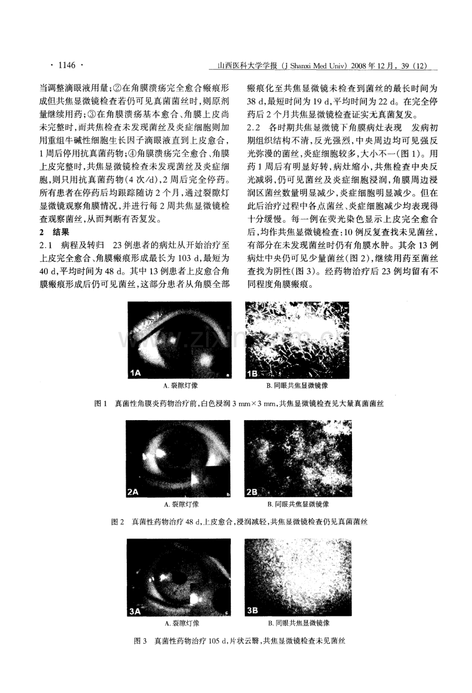 激光共焦显微镜在临床药物治疗真菌性角膜炎中的应用.pdf_第2页