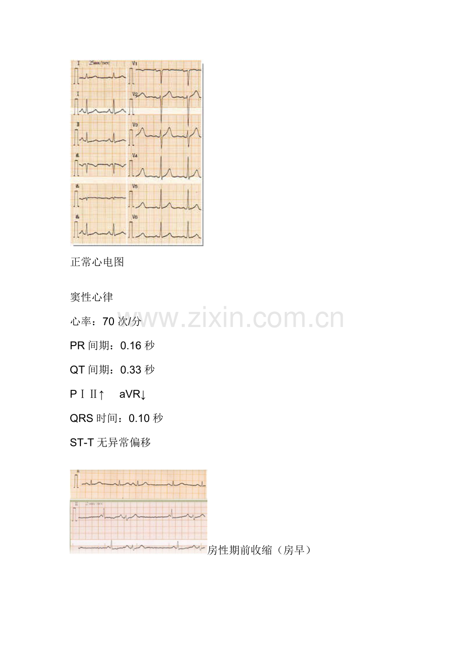 正常心电图.doc_第1页