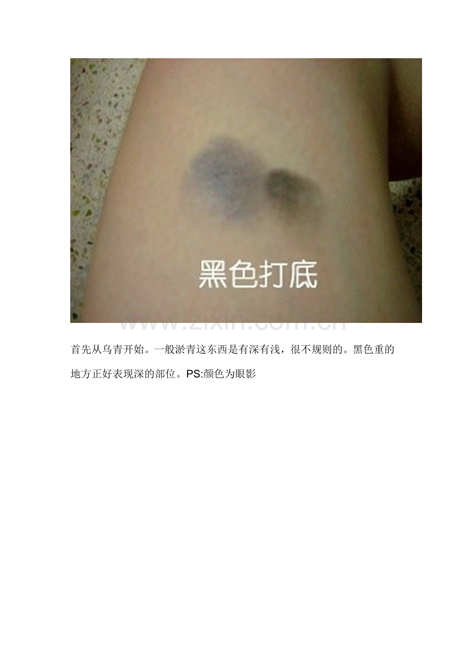 装伤请病假之必备伤口.doc_第2页