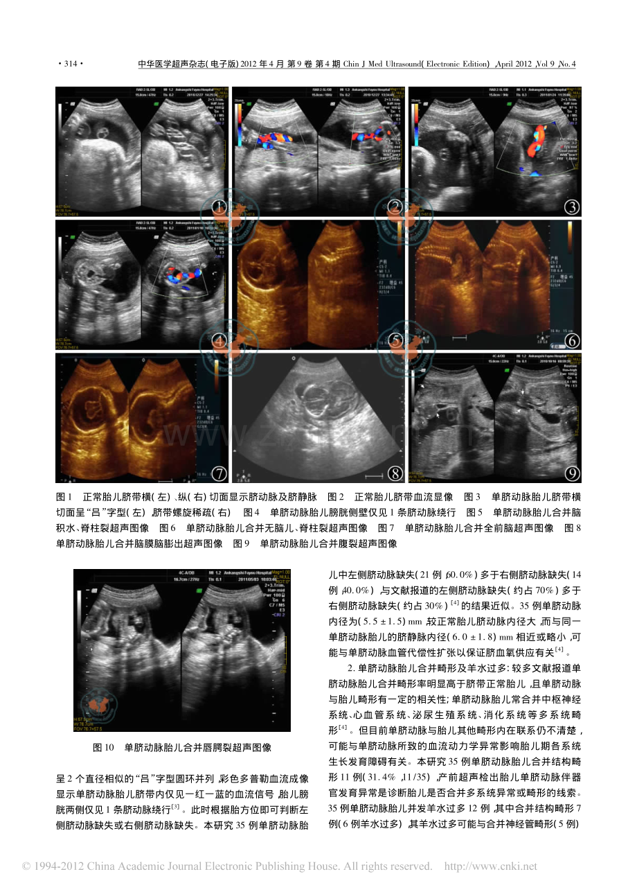 产前超声诊断胎儿单脐动脉及临床分析.pdf_第2页