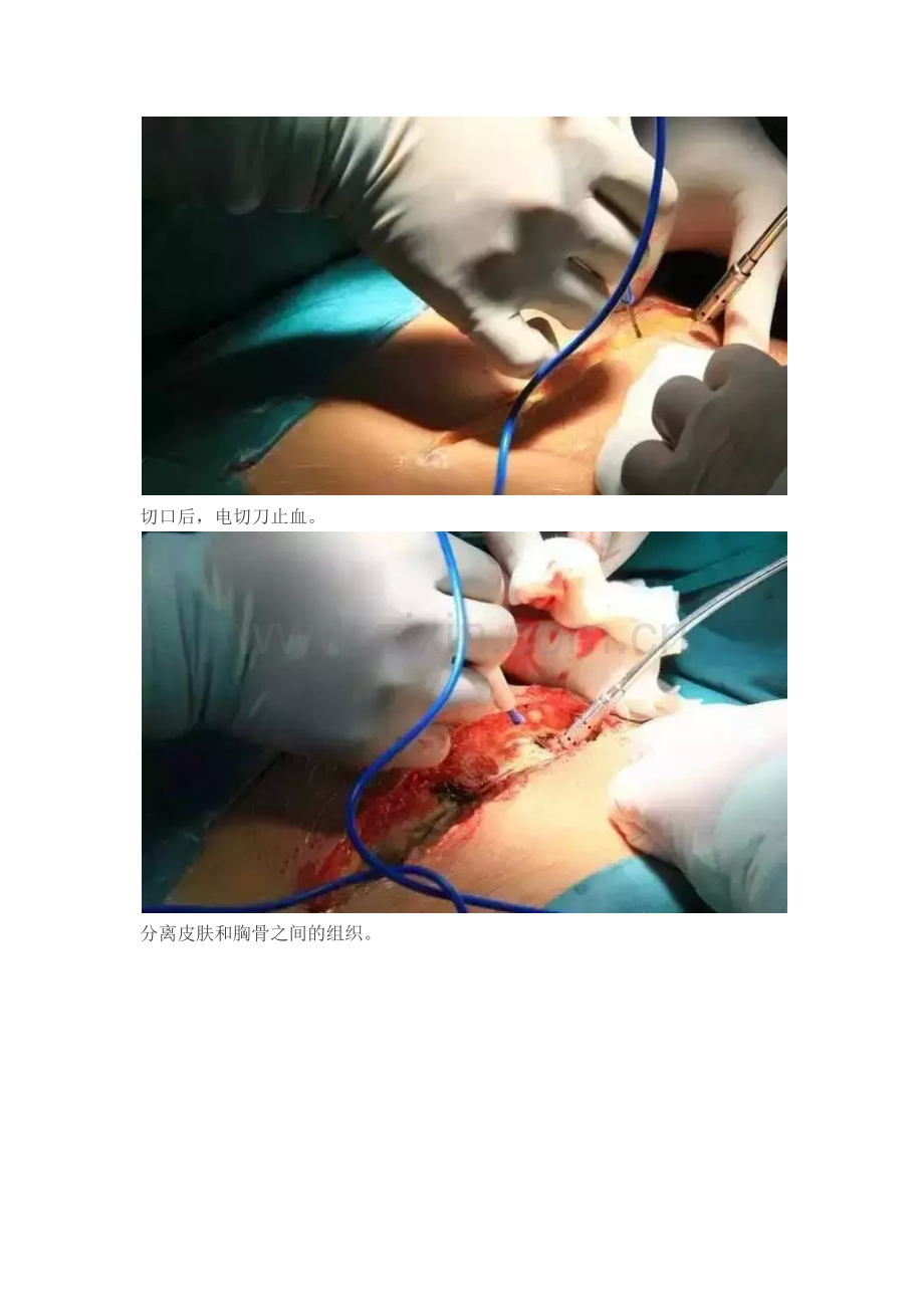 心脏瓣膜病置换手术过程图解及患者关心问题解析.docx_第2页