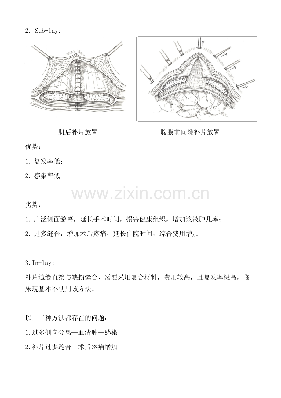 巴德腹壁切口疝手术开放术式.pdf_第2页