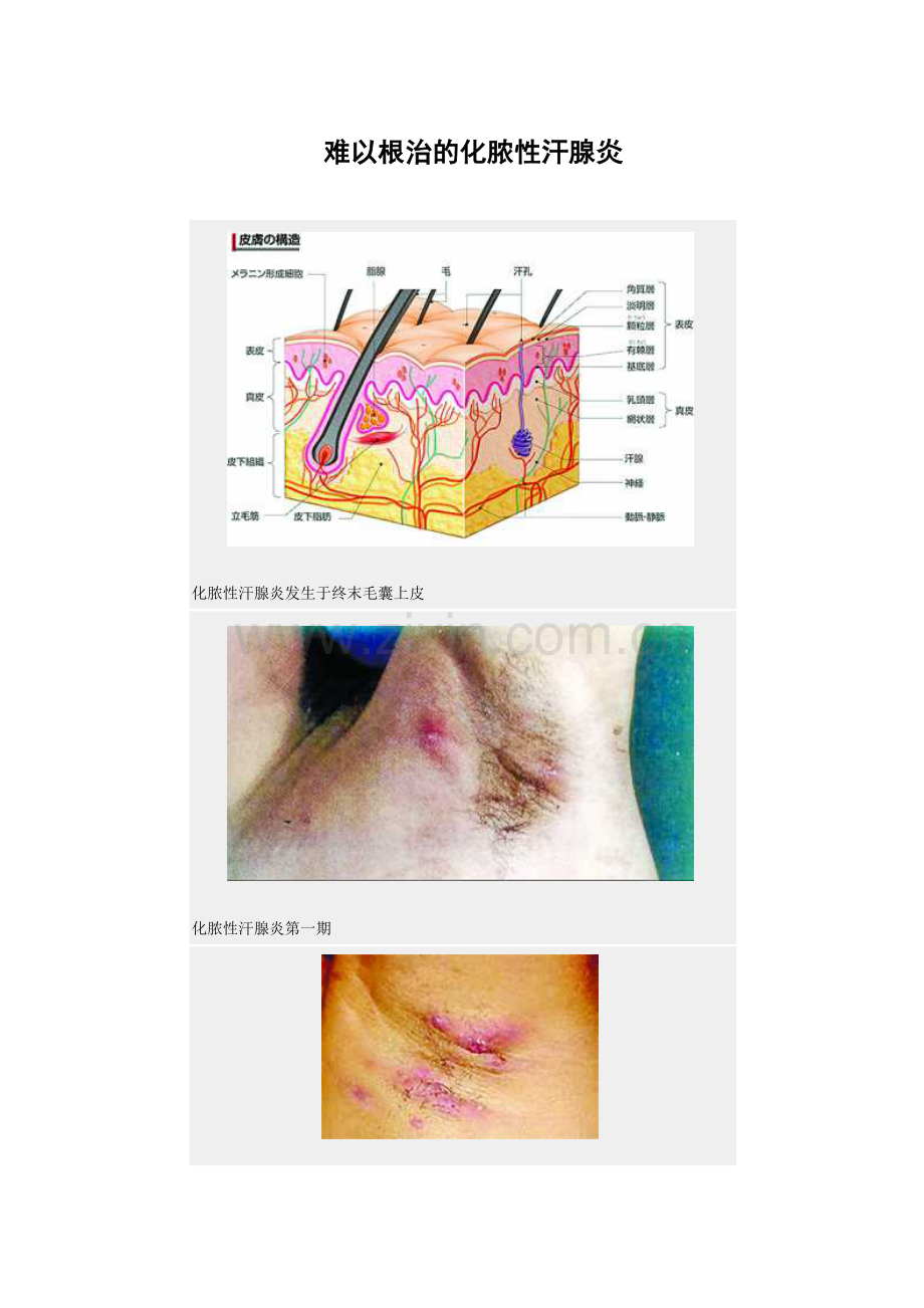 难以根治的化脓性汗腺炎.docx_第1页