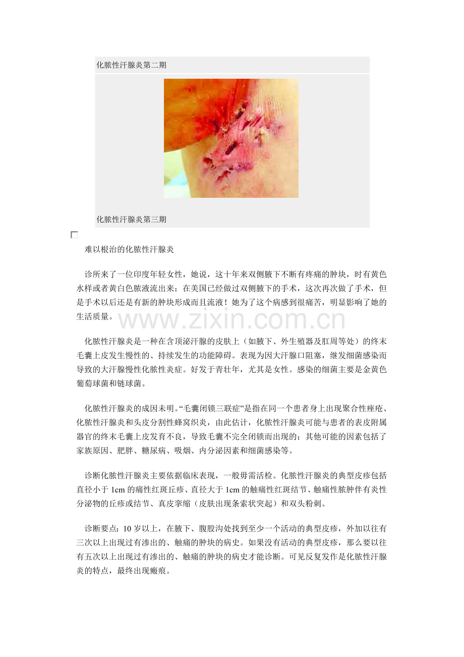 难以根治的化脓性汗腺炎.docx_第2页