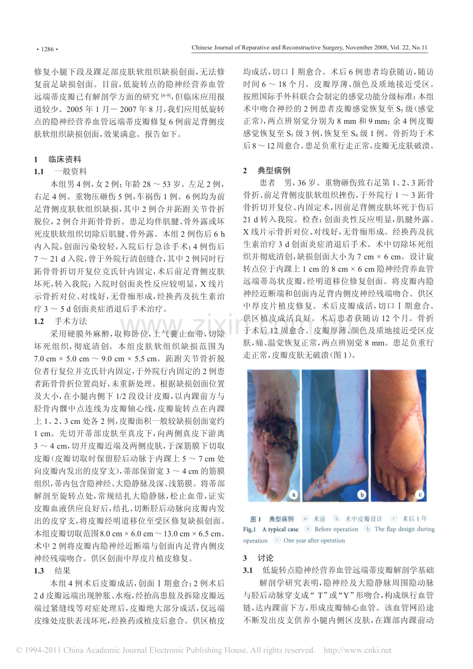 低旋转点的隐神经营养血管远端蒂皮瓣修复前足背侧缺损创面.pdf_第2页