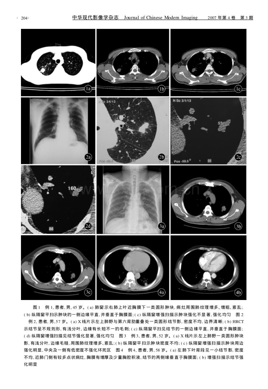肺炎性假瘤的影像学诊断.pdf_第2页