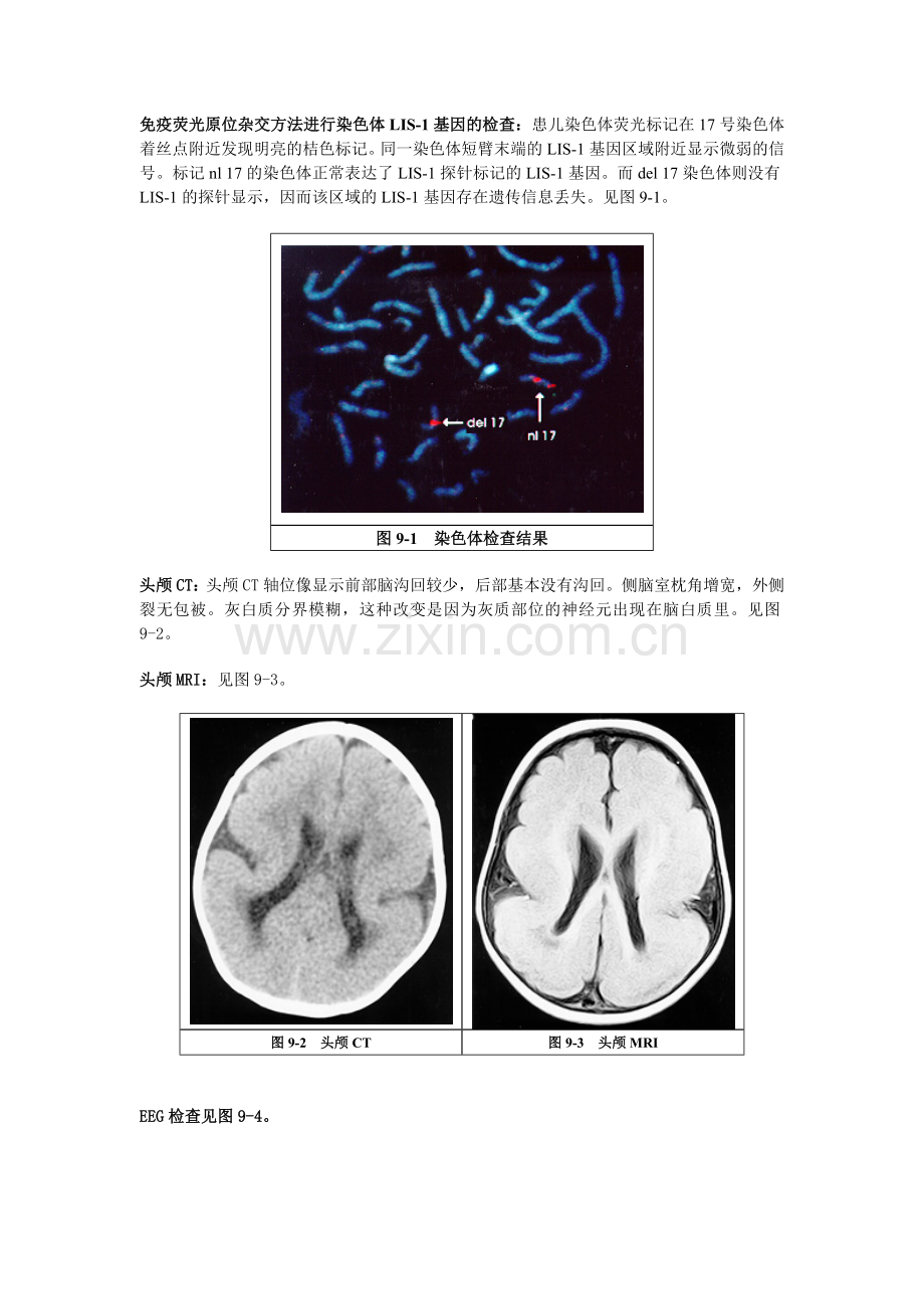 神经科疑难病例——无脑回症.docx_第2页