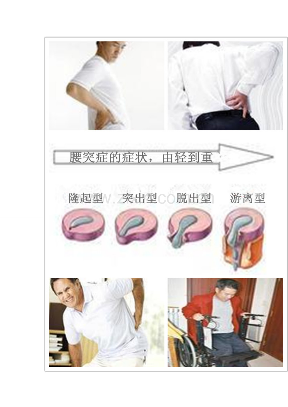 腰椎间盘突出的简介.doc_第2页