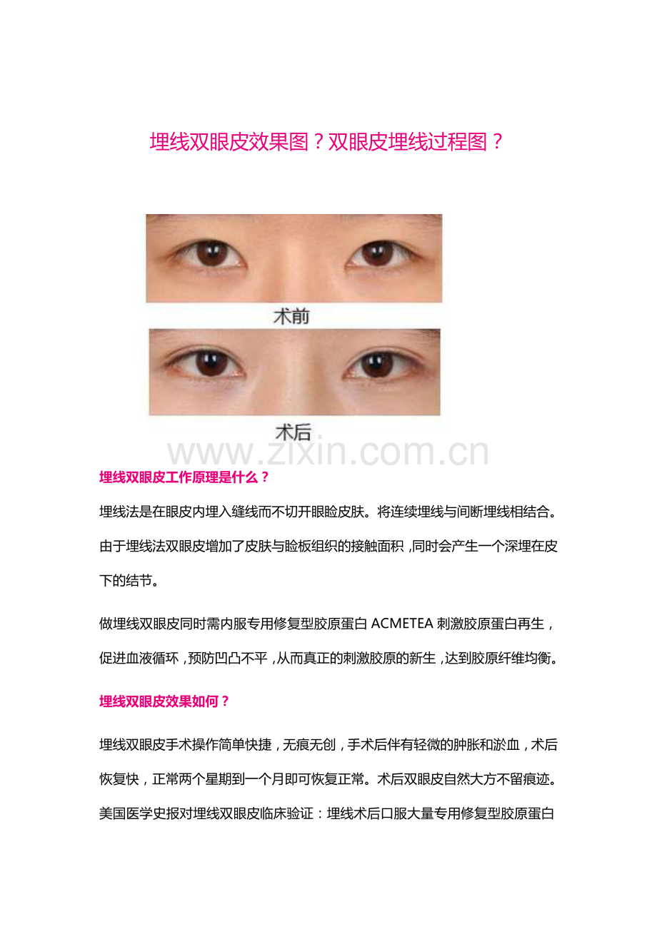 埋线双眼皮效果图？双眼皮埋线过程图？.docx_第1页