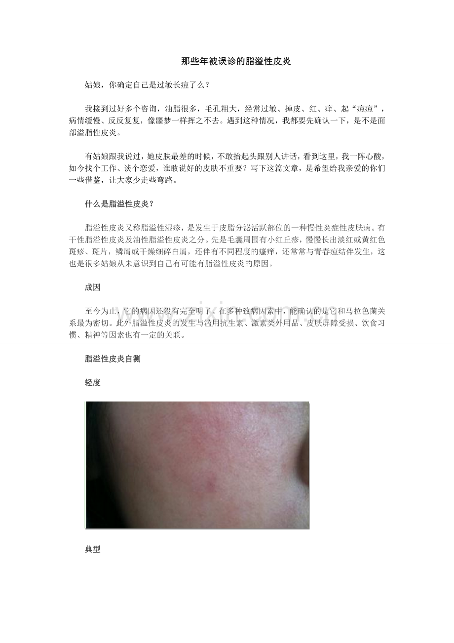 那些年被误诊的脂溢性皮炎.doc_第1页