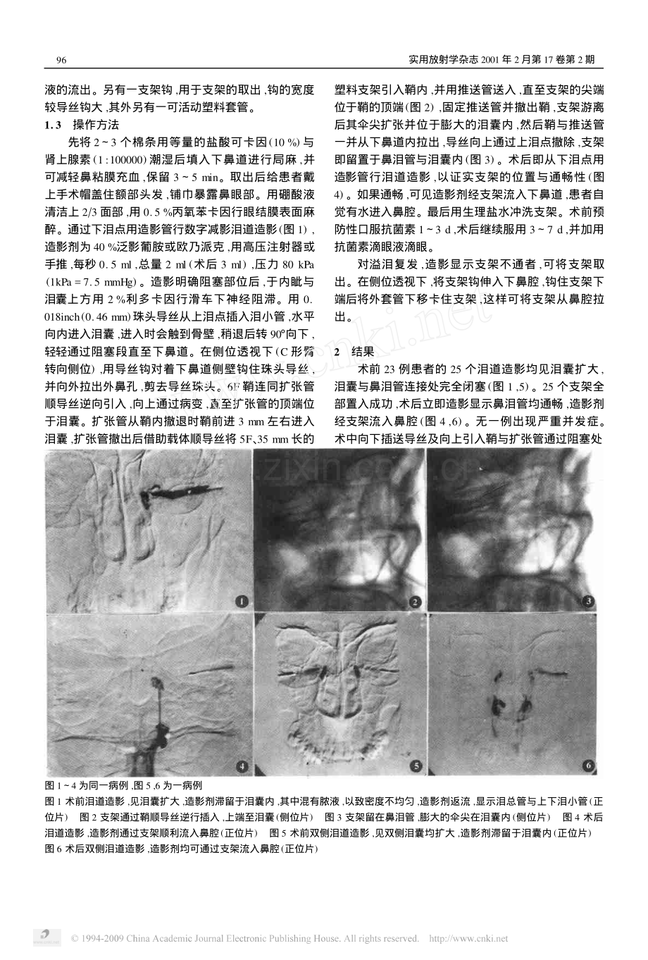 介入性塑料支架置入术治疗鼻泪管阻塞.pdf_第2页