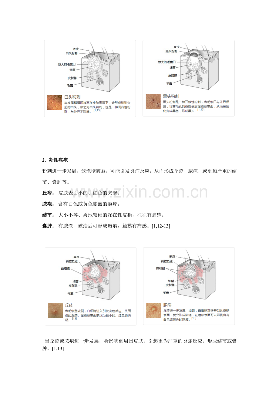 什么是痤疮.doc_第2页