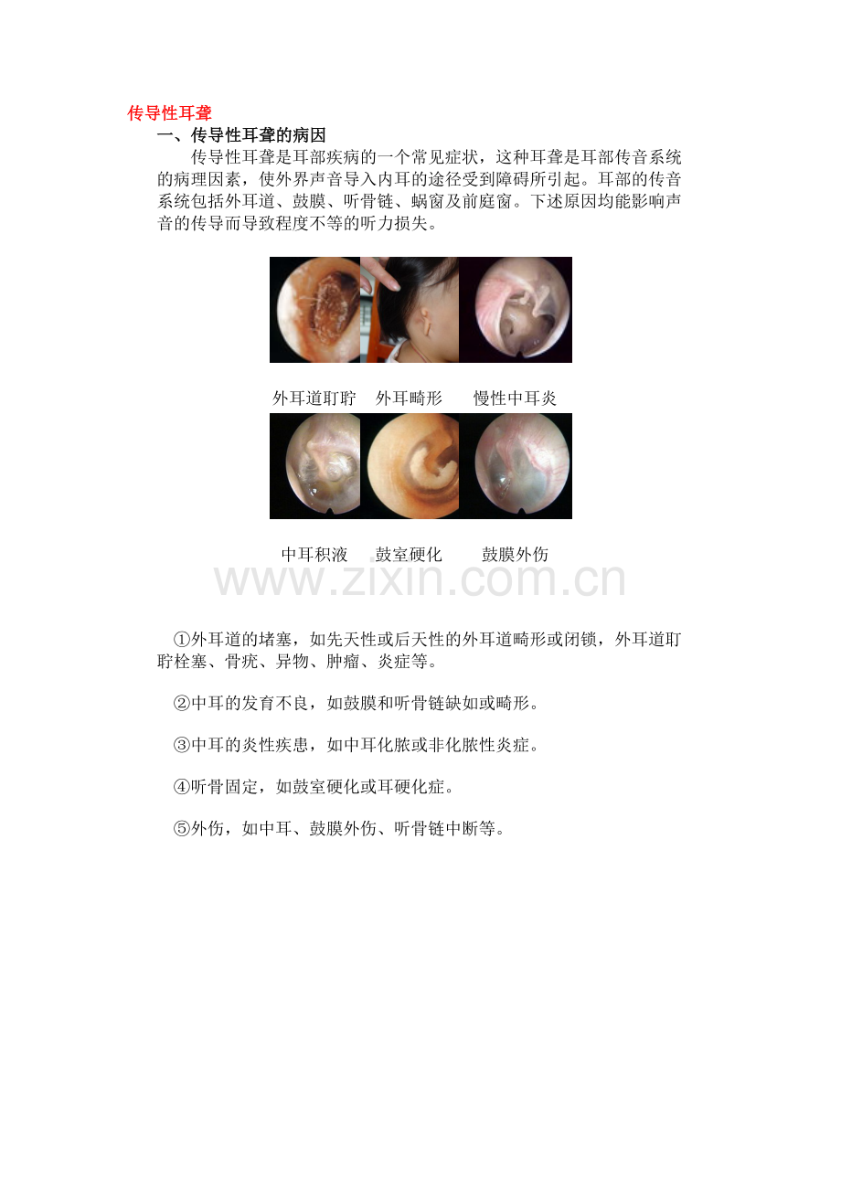 传导性耳聋.doc_第1页