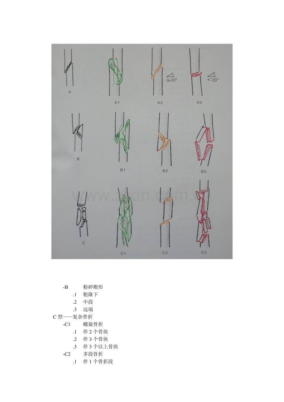 股骨干骨折.doc_第2页
