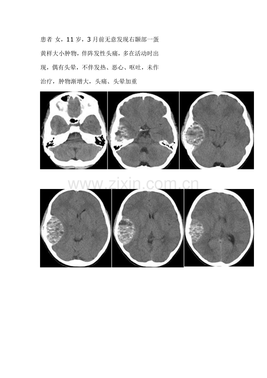 颅骨动脉瘤样骨囊肿.doc_第1页