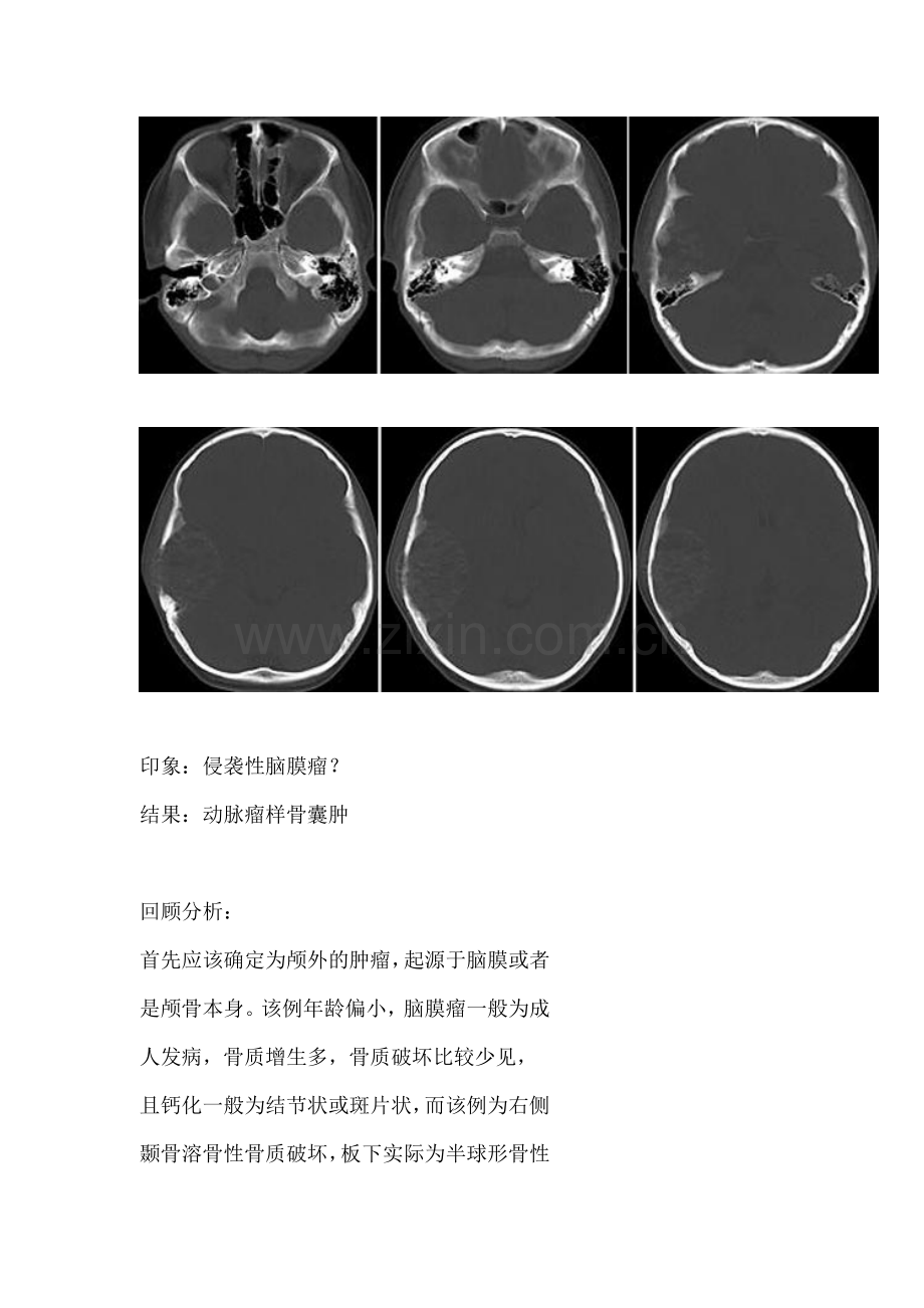 颅骨动脉瘤样骨囊肿.doc_第2页