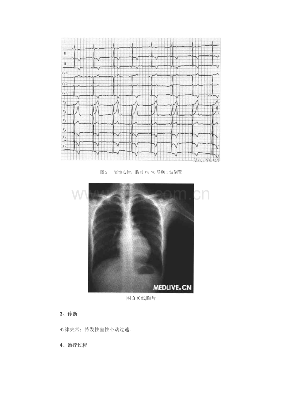 少女突发突止心慌.doc_第2页