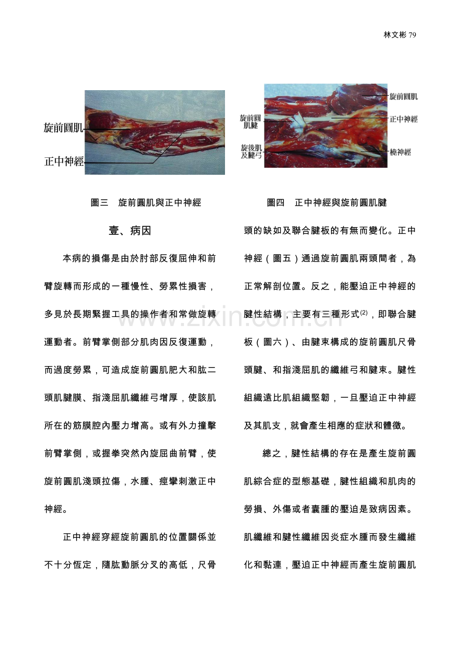 谈正中神经卡压徵候群-旋前圆肌综合症.doc_第2页