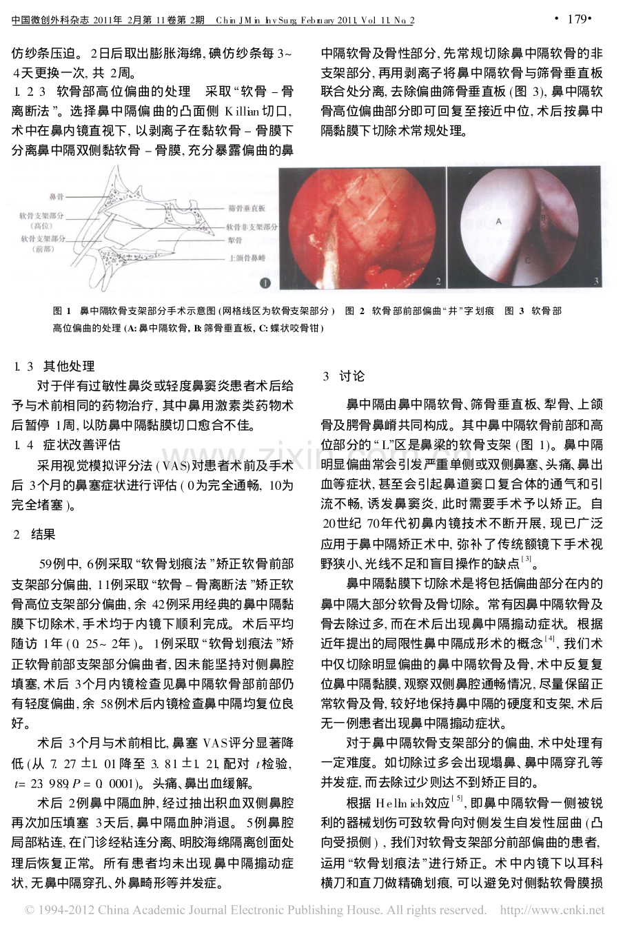 鼻内镜下鼻中隔偏曲矫正的手术技巧.pdf_第2页