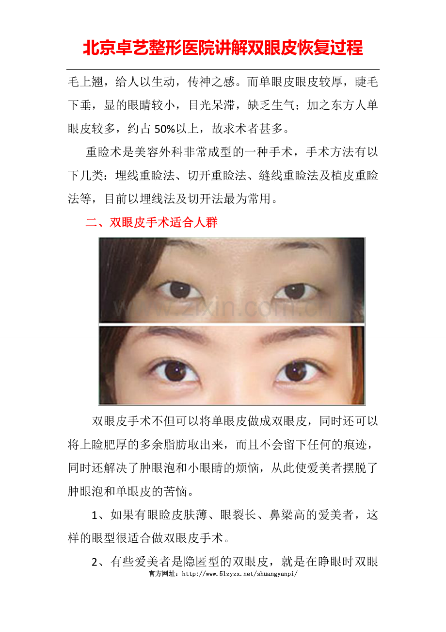 双眼皮恢复过程.doc_第2页