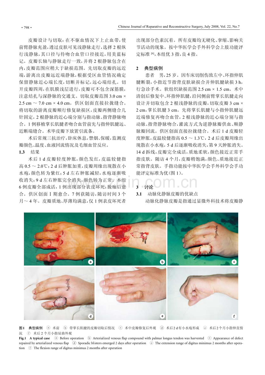 动脉化静脉皮瓣急诊修复手指软组织缺损.pdf_第2页