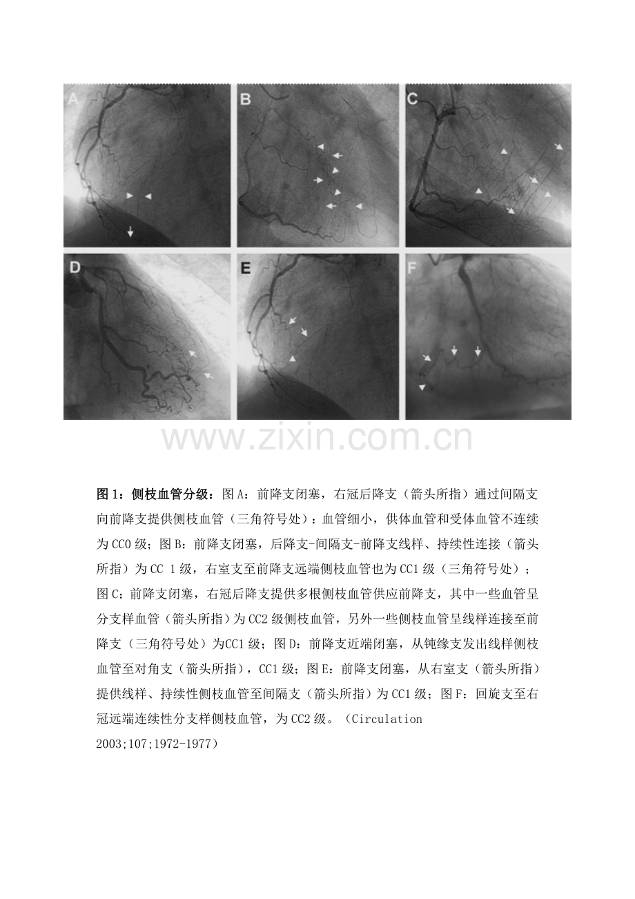 逆向导引钢丝技术侧枝血管的选择.doc_第2页
