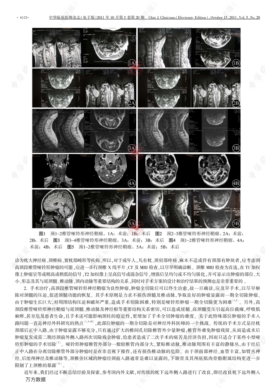 经改良枕下远外侧入路显微手术切除高颈段椎管哑铃形神经鞘瘤.pdf_第2页