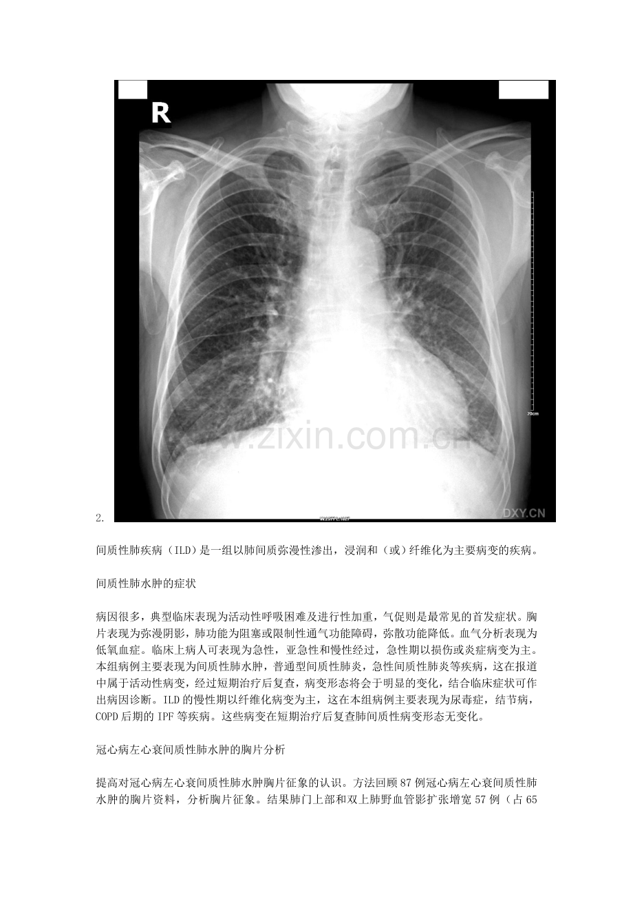 间质性肺水肿.doc_第2页
