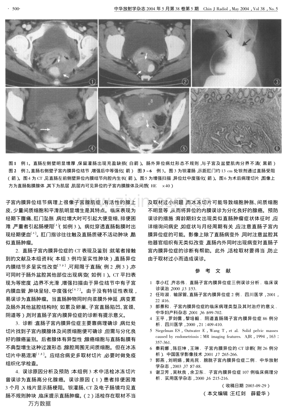 直肠子宫内膜异位症的CT表现.pdf_第2页