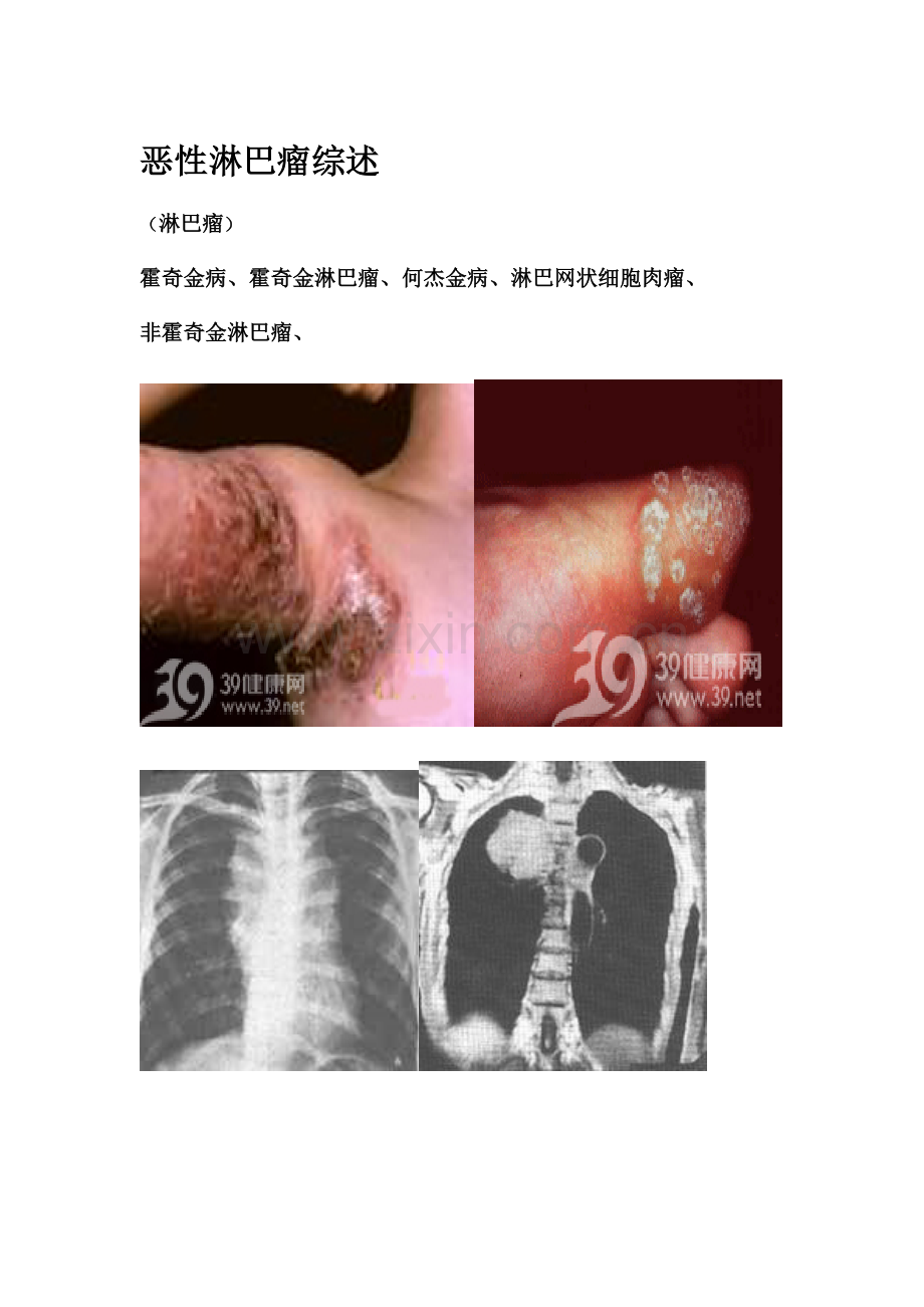 恶性淋巴瘤综述.doc_第1页