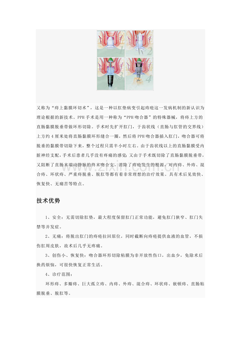 PPH环切术.doc_第2页