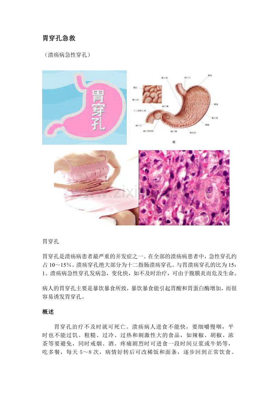 胃穿孔急救.doc_第1页