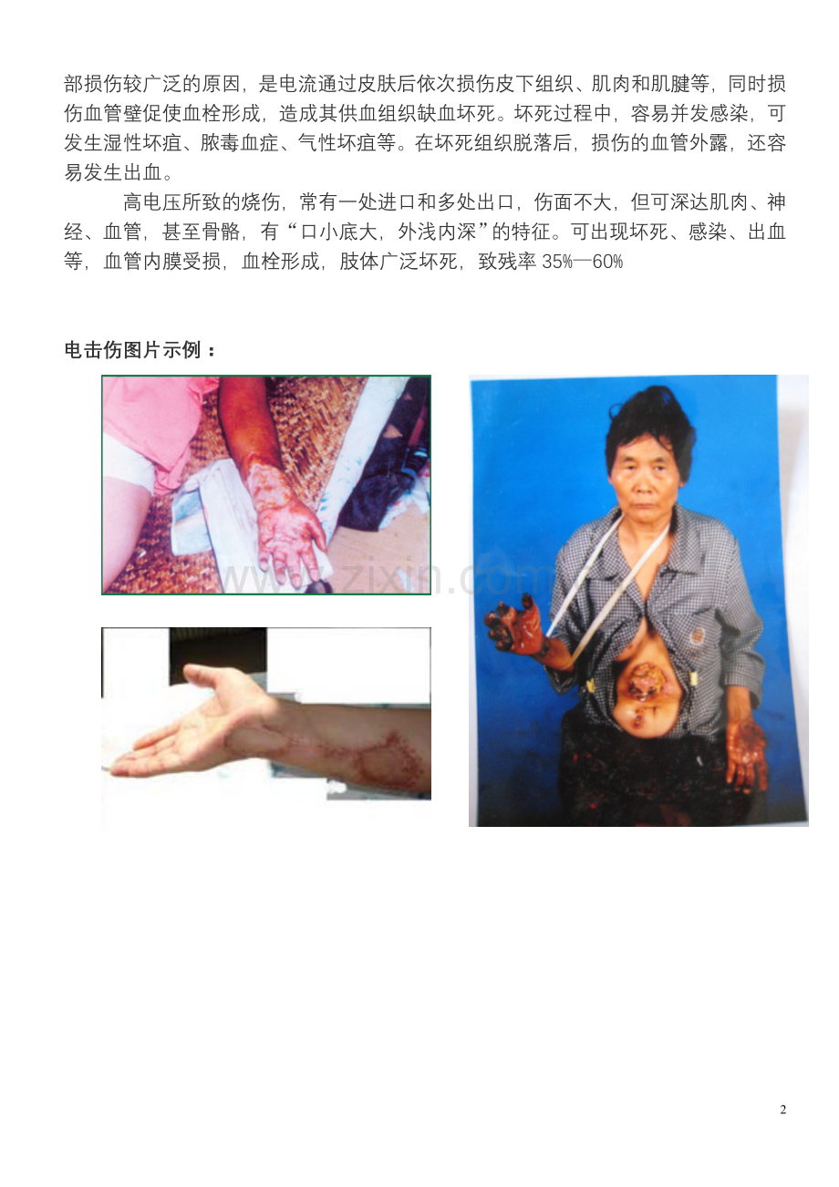 电击伤的主要特点.doc_第2页