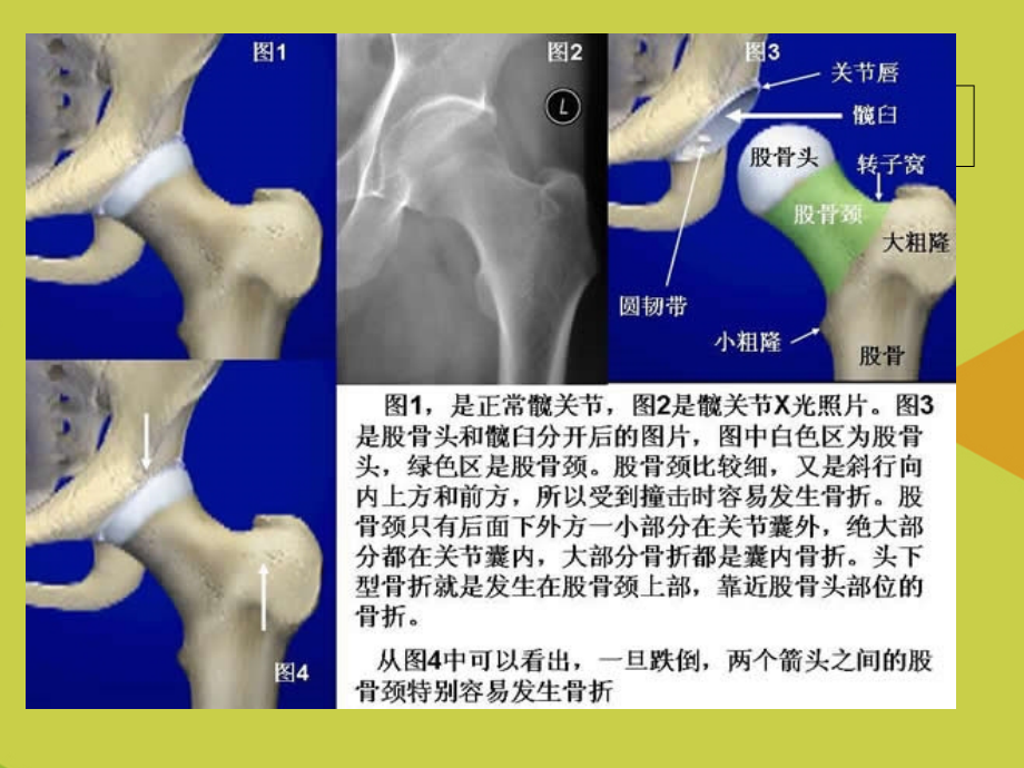骨科知识ppt髋关节置换.ppt_第2页