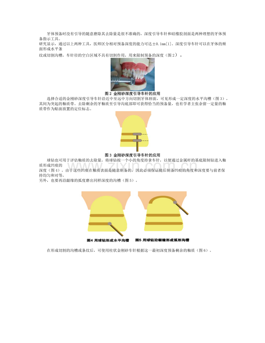 瓷贴面修复牙体预备中的操作要点.docx_第2页