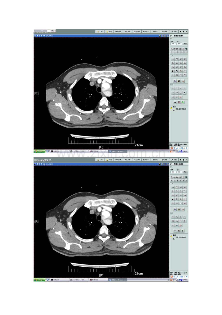 CT影像主动脉夹层.doc_第1页