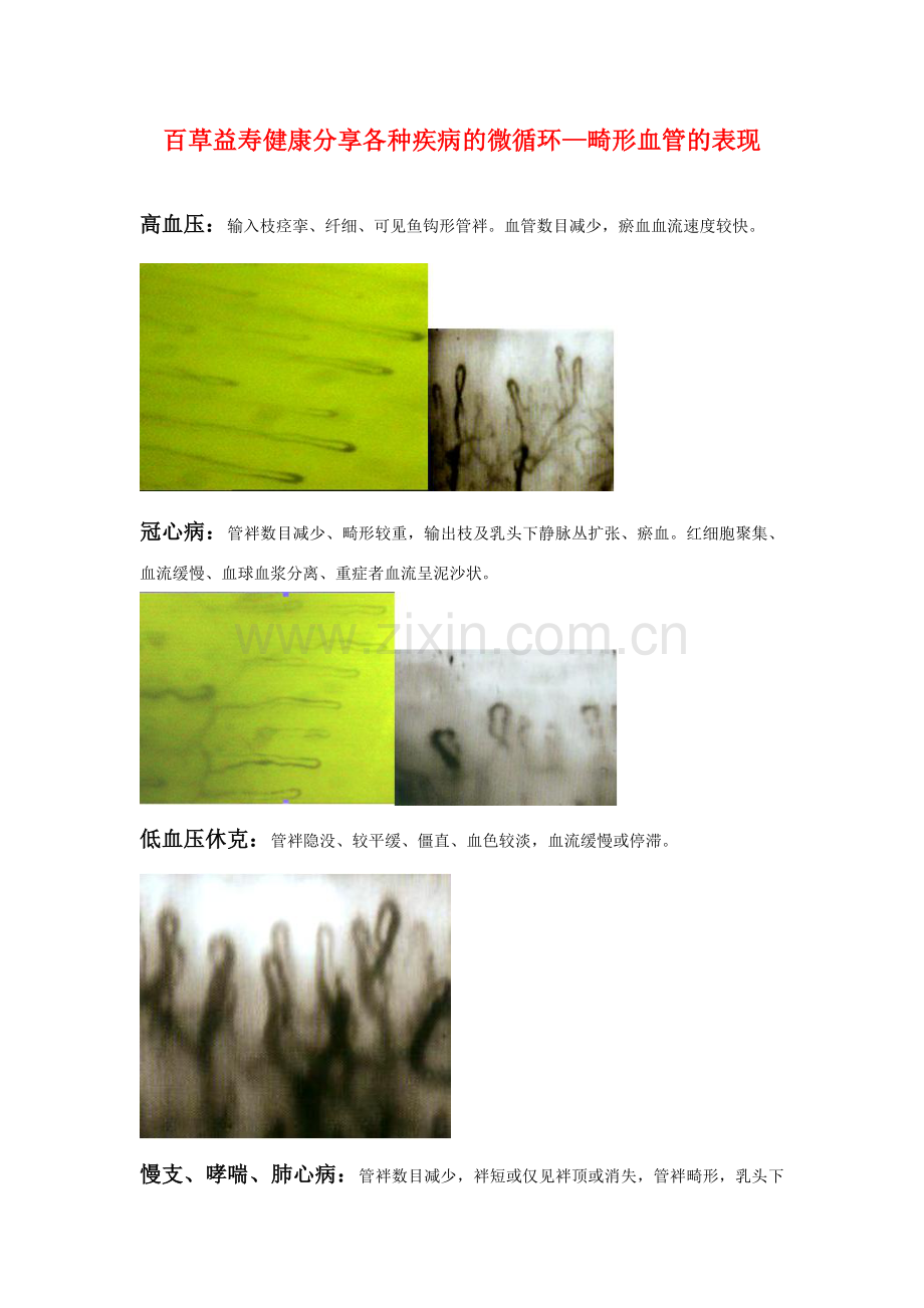 百草益寿健康分享各种疾病的微循环-畸形血管的表现.doc_第1页