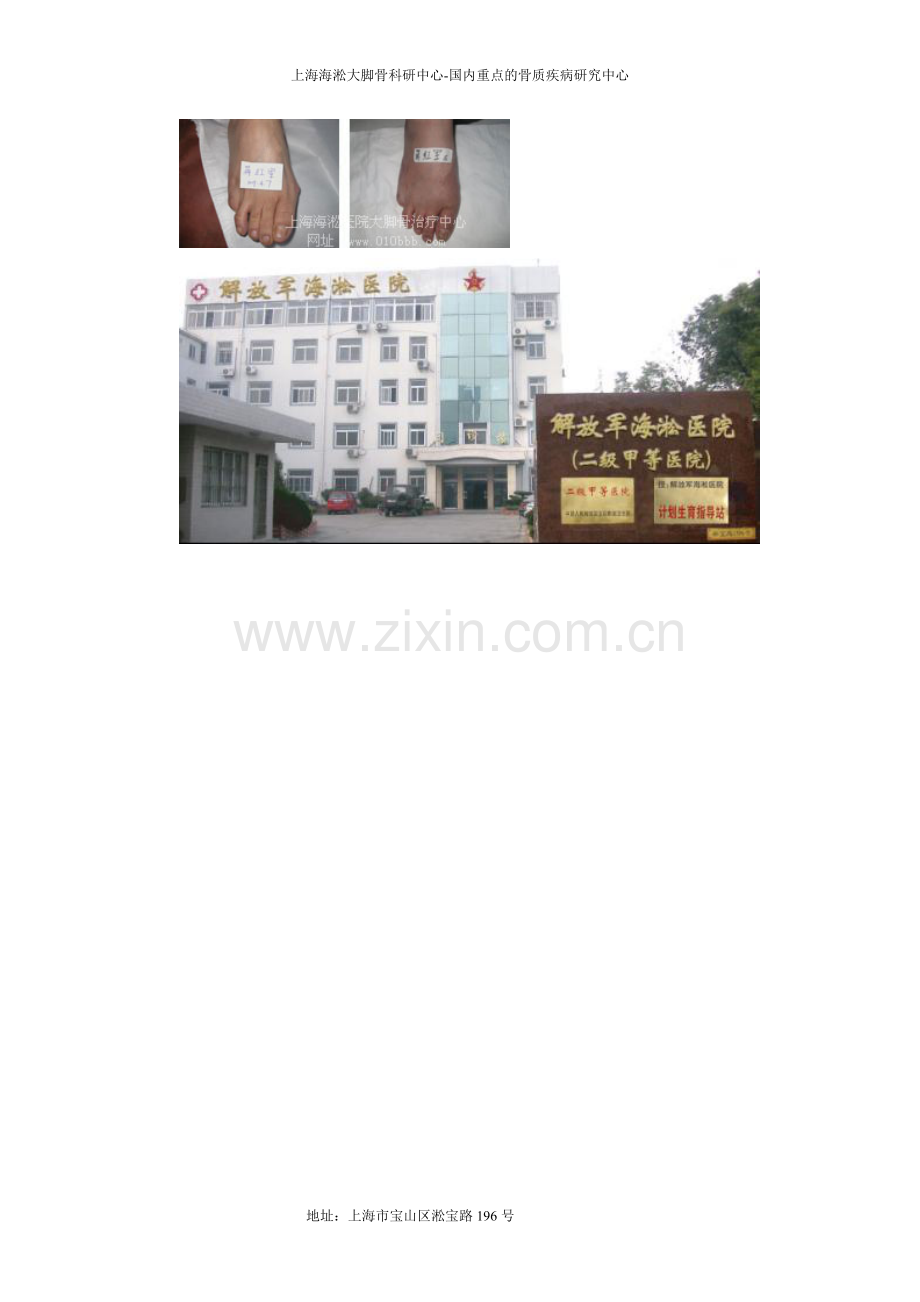 拇外翻手术过程.doc_第2页