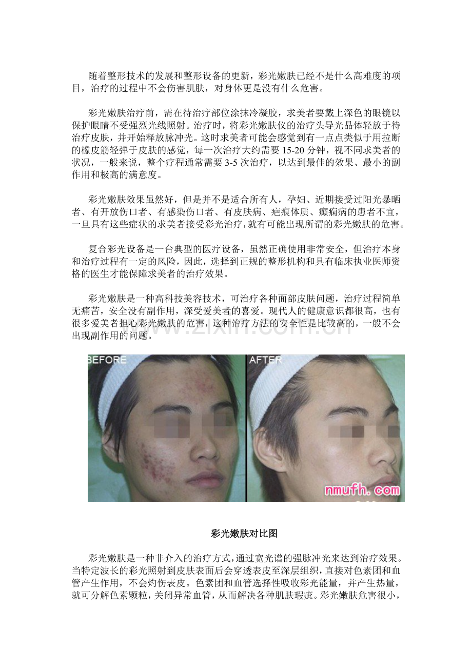 彩光嫩肤的危害.doc_第2页