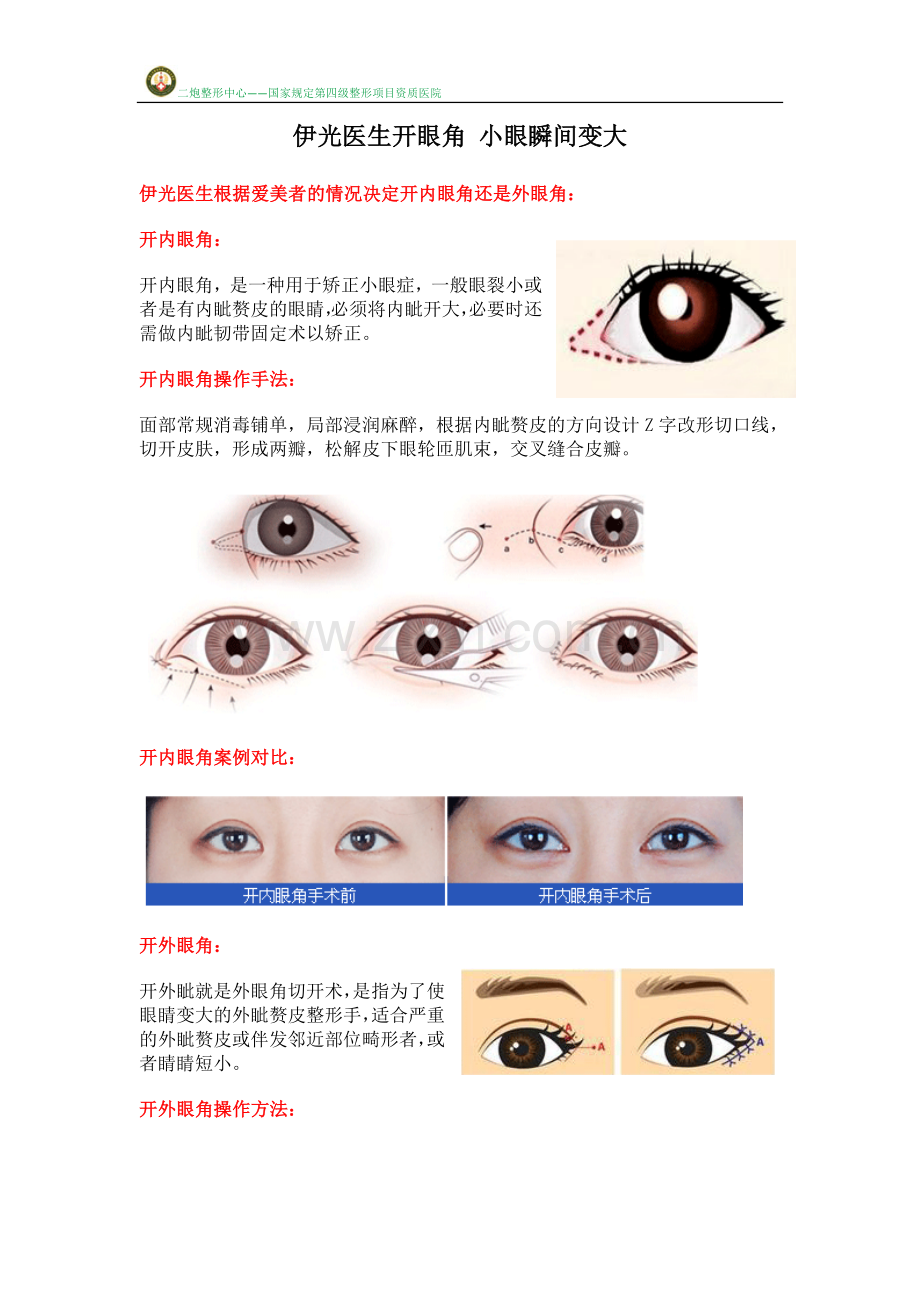 伊光医生开眼角 小眼瞬间变大.docx_第1页