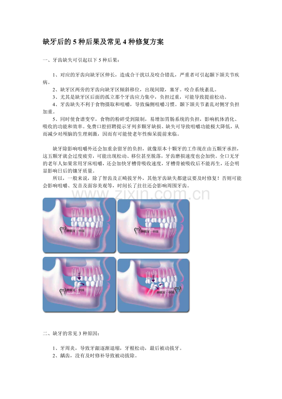 缺牙后的5种后果及常见3种修复方案.doc_第1页