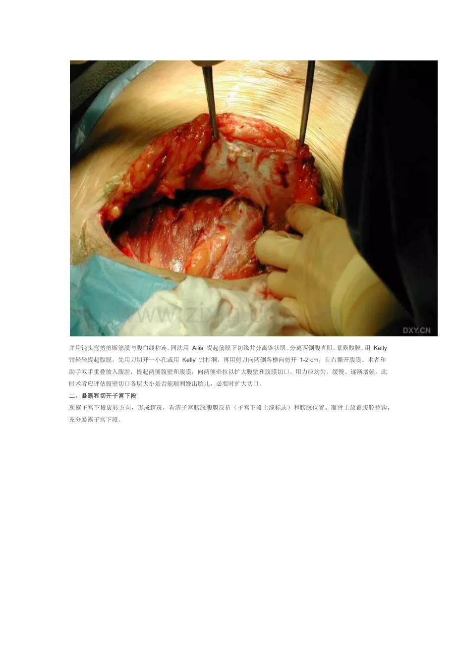 剖宫产手术流程(含图).doc_第2页