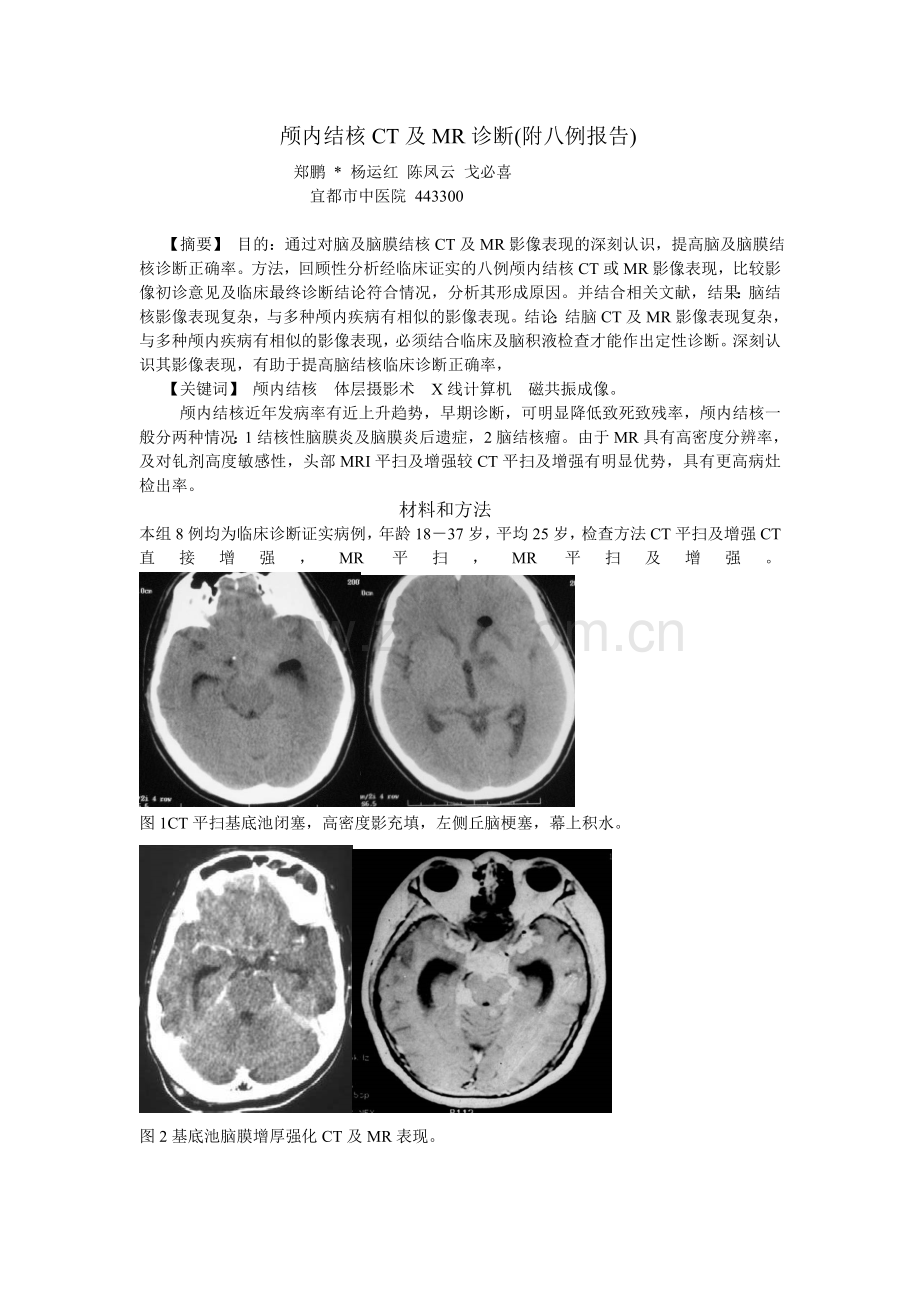 脑结核CT诊断及MRI诊断.doc_第1页