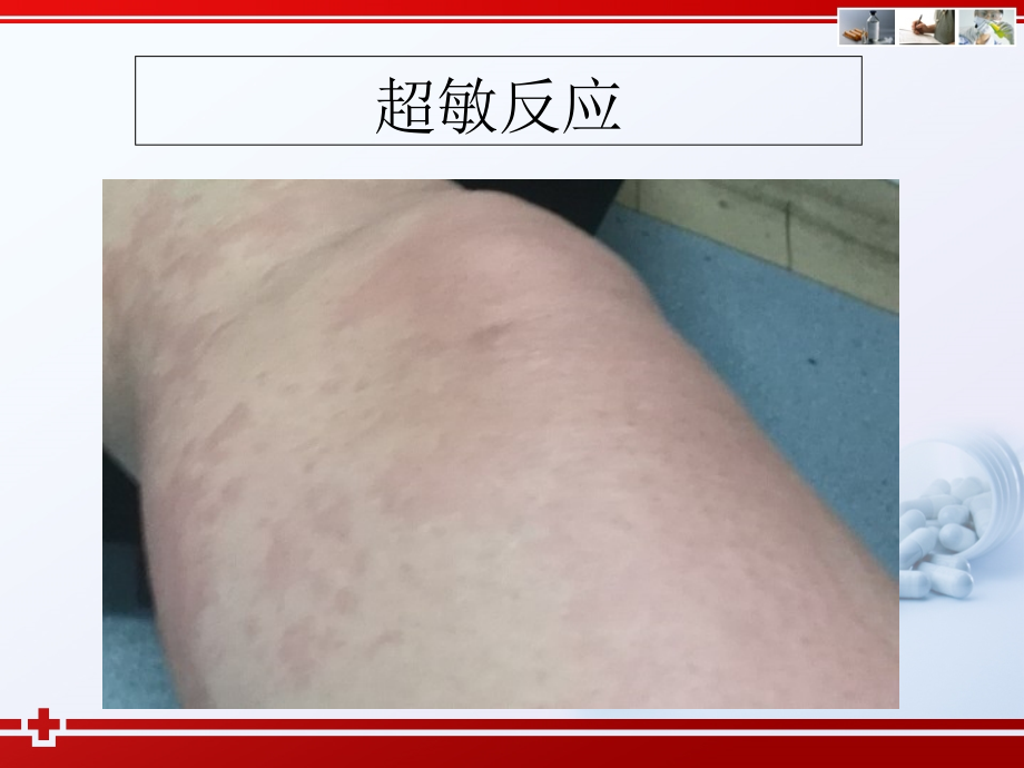 变态反应性疾病的药物治疗.ppt_第1页