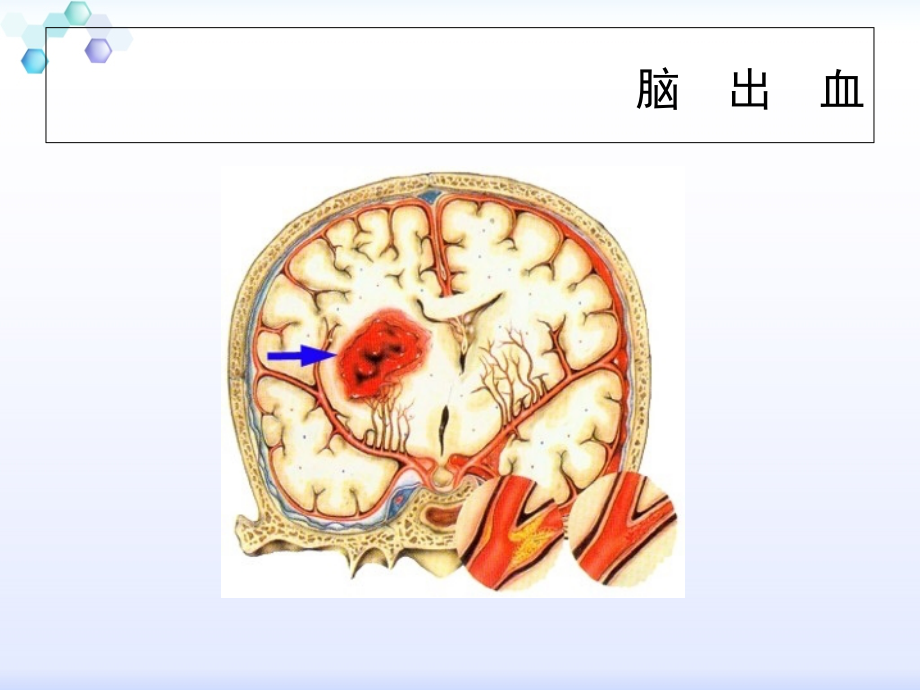 不同部位脑出血的评估与观察.ppt_第2页