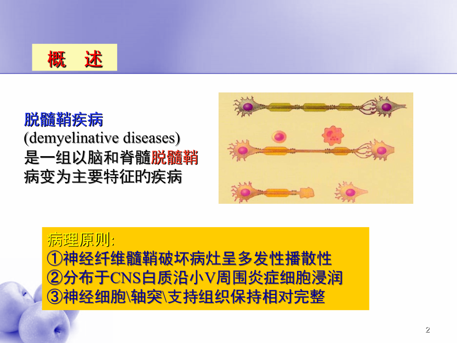 脱髓鞘疾病课件.ppt_第2页